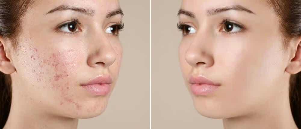 ព្យាបាលទង់សុក T stem cell