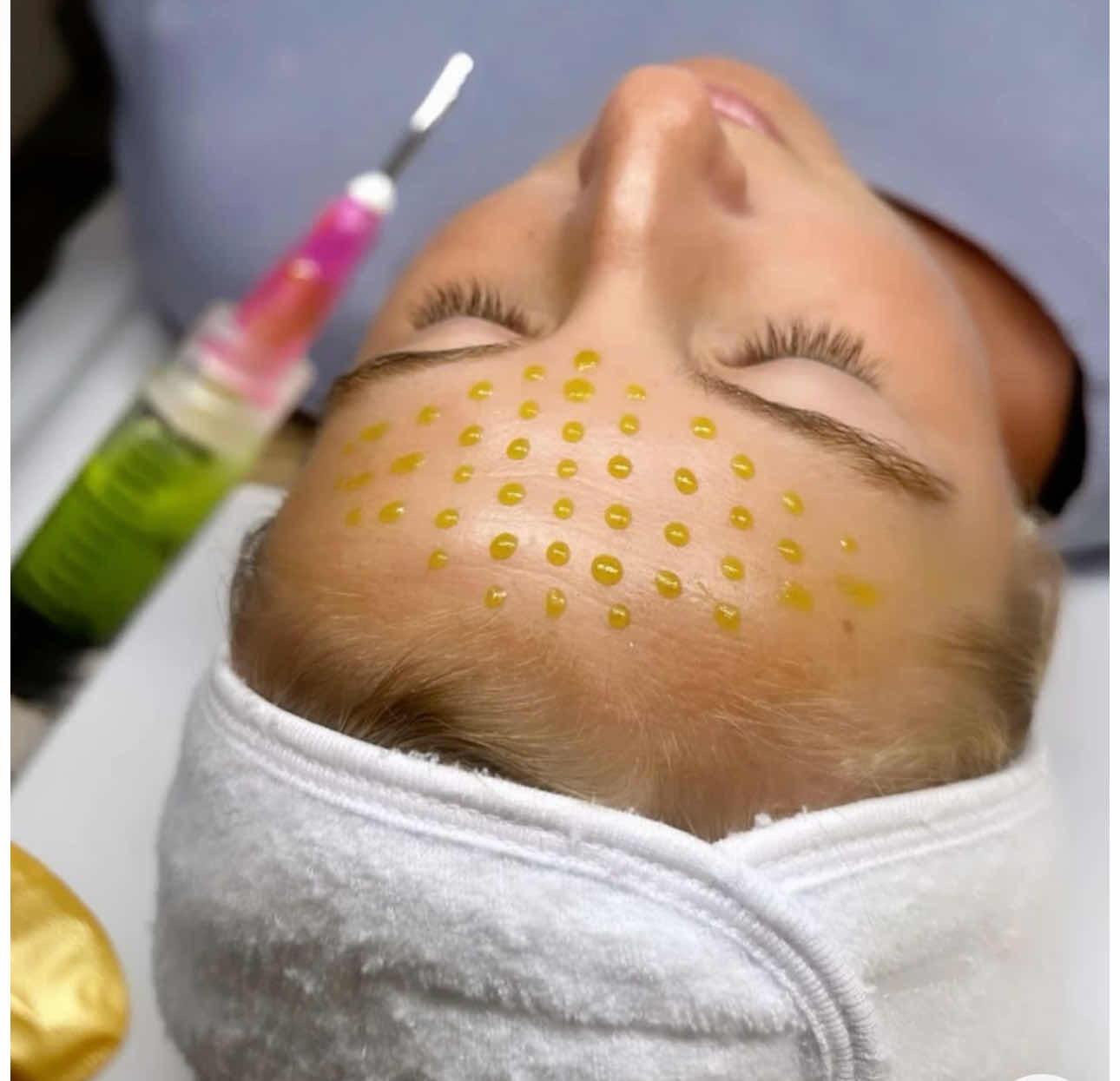 ដើរម្ជុលទាលមុខតឹង / peeling tightening