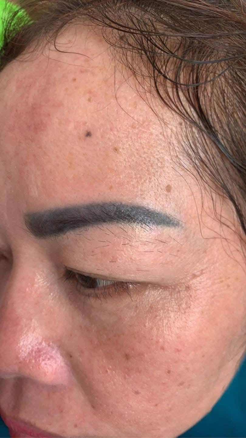 កែរចញ្ចើមលុបមួយដង Laser