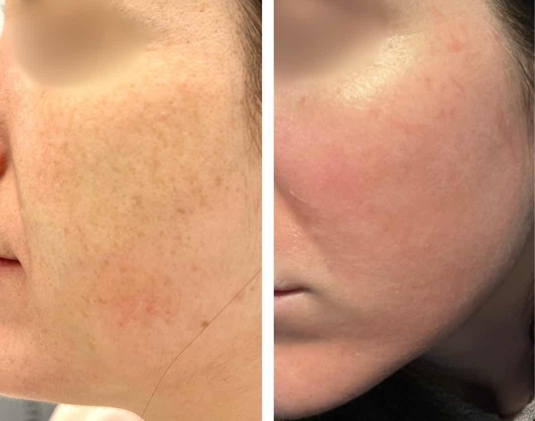 ភៀលស្បែកមុខ TOX PEEL
