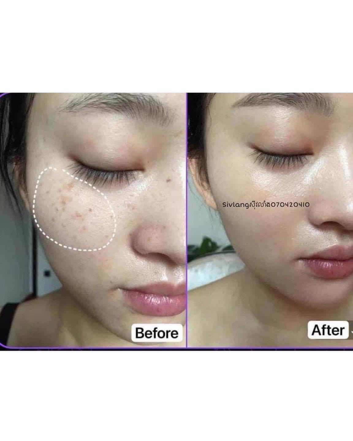 Medipeel