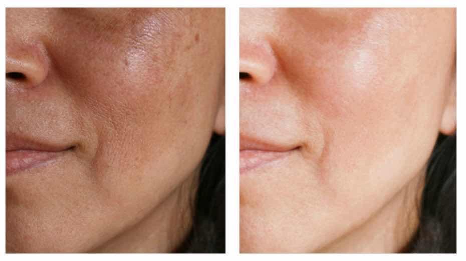 បាញ់ជាំអាចជ៍រុយ Laser