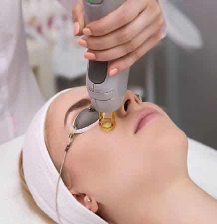 បាញ់បំបាត់ស្នាមLaser
